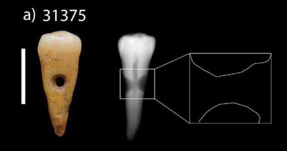dientes humanos neolítico