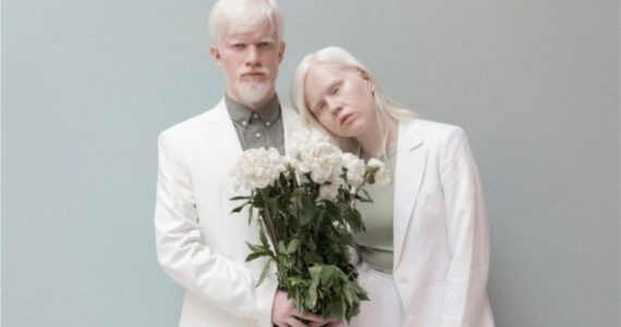 Albinos: Causas y problemas de salud de las personas con albinismo