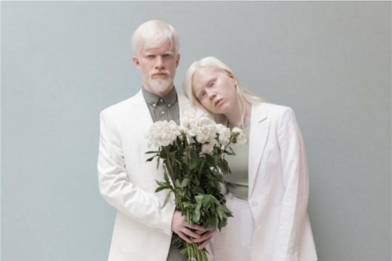 Albinos: Causas y problemas de salud de las personas con albinismo