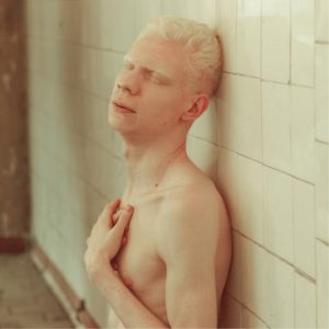 Cómo es un albino